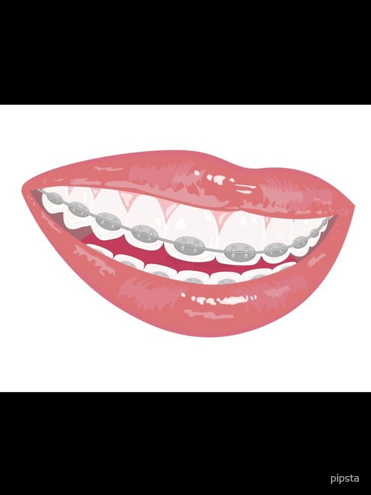 Braces by Sipsta